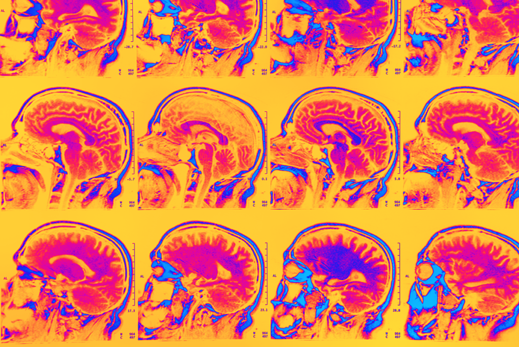 a grid of MRI images of a brain